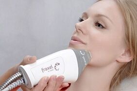 intipati prosedur peremajaan kulit muka pecahan